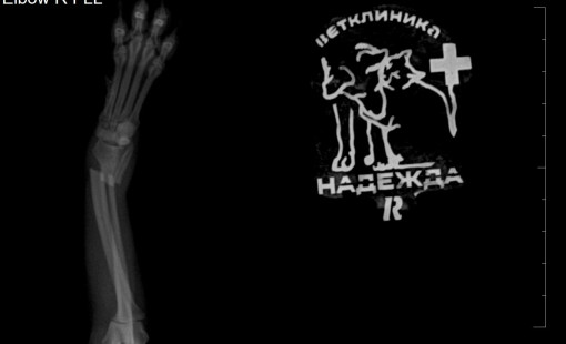 Снимок перелома правого предплечья